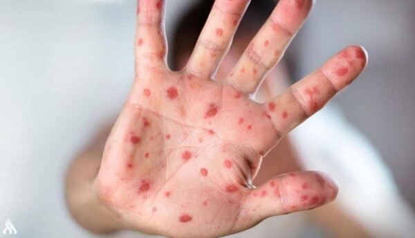 Марокко Сообщает о Первом Случае Оспы Обезьян